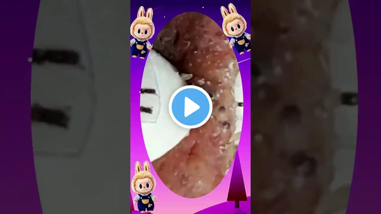 Blackheads Removal | Acne Treatment and Very Satisfying Satisfying Pimple pop #blackheads