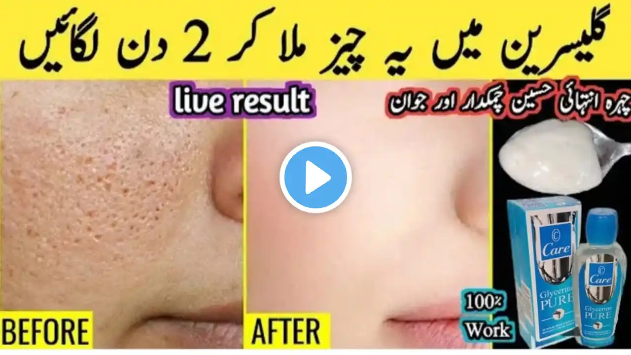 glycerine and rose water for skinwhitening Iskin whitening cream |Glowing Skin Remedy