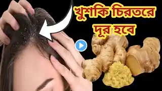 খুশকি দূর করার সেরা ঘরোয়া উপায়/Dandruff Permanently/Best Home Remedy for Dandruff/SaimoonVlog