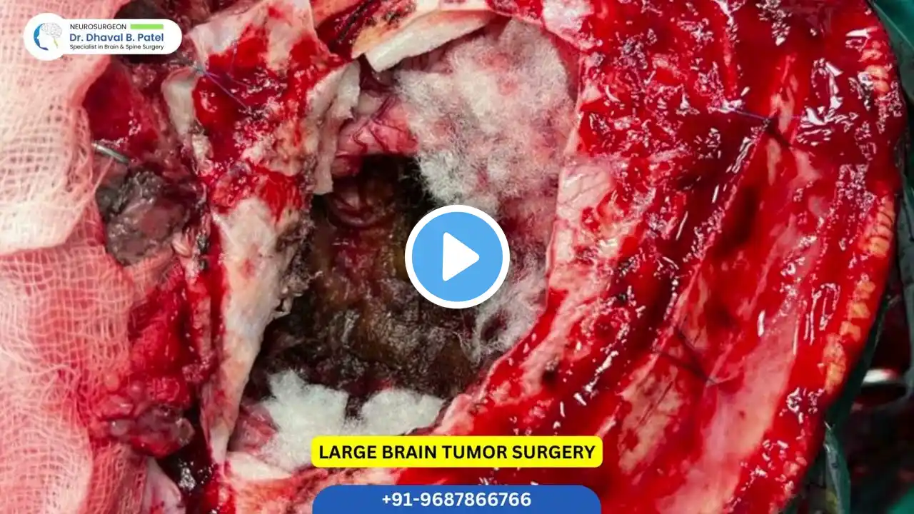 Large Brain Tumor Surgery, Brain surgery, Neurosurgery, Tumor resection, Ankleshvar, Surat, Gujarat.