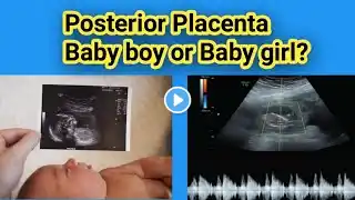 Posterior placenta Baby boy or Baby Girl?| Gender Prediction |Radiology vibes