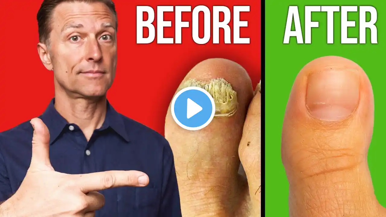 The Fastest Way to Get Rid of Toenail Fungus