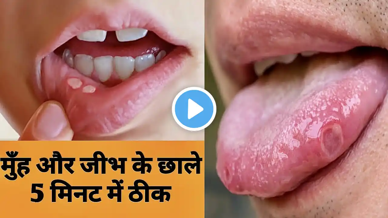 5 मिनट में मुंह व जीभ के छाले गायब,मुंह के छालों का घरेलू उपचार How to treat mouth ulcer home remedy