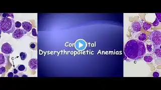 Congenital Dyserythropoietic Anemias; Definition, Types, Symptoms, Diagnosis, Treatment