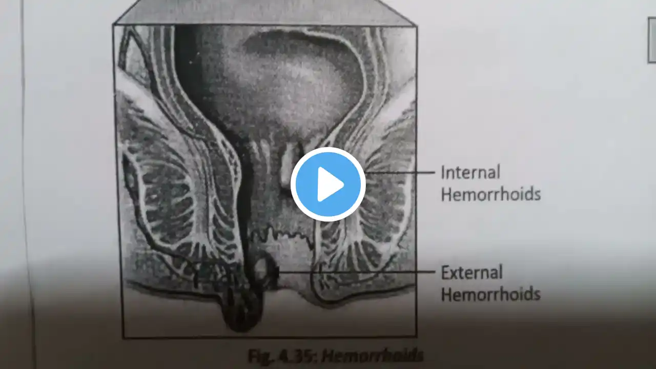 Hemorrhoids !! Types ! Cause ! Pathophysiology ! Sign & Symptom ! Diagnostic evaluation ! Management