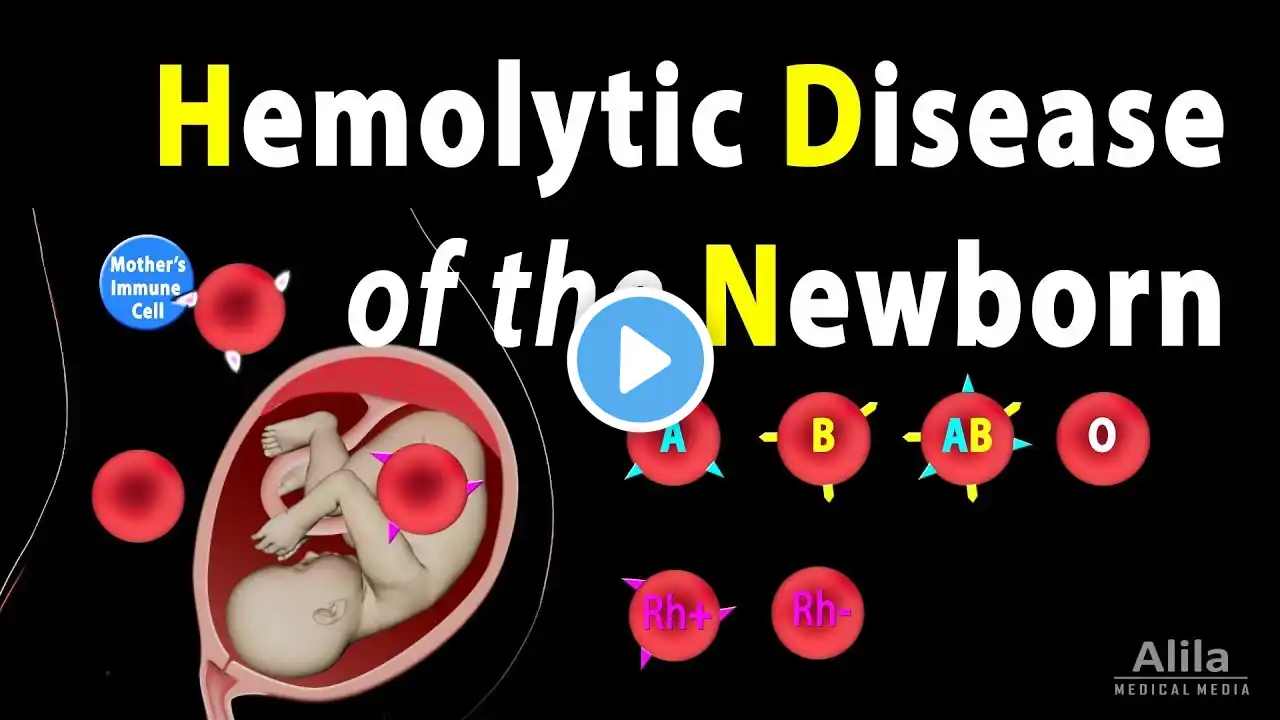 Hemolytic Disease of the Newborn (HDN), Animation