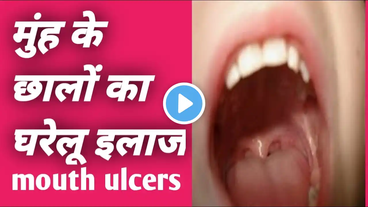 मुंह के छालों का घरेलू इलाज|home remedies for mouth ulcers|  rajiv dixit ayurvedic