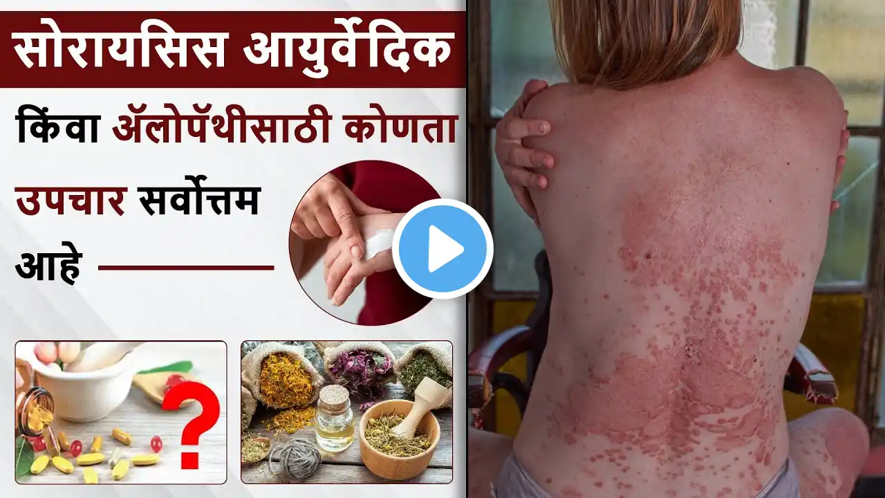 सोरायसिस आयुर्वेदिक किंवा ॲलोपॅथीसाठी कोणता उपचार सर्वोत्तम आहे | Psoriasis Best Treatment Option