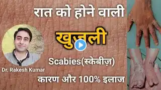 खुजली(स्केबीज़) के कारण, लक्षण, बचाव और घरेलू उपचार |Scabies Treatment |Scabies Home Remedies