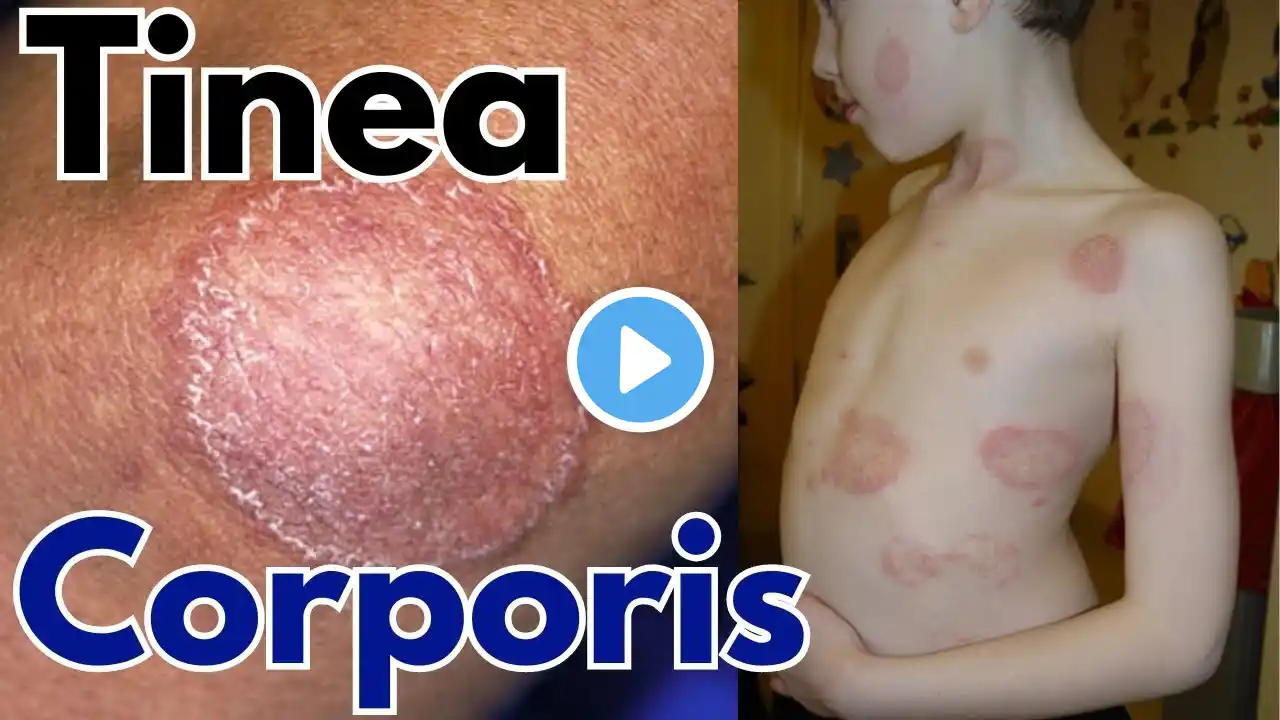 Tinea corporis infection |  Ring worm symptoms, treatment and causes