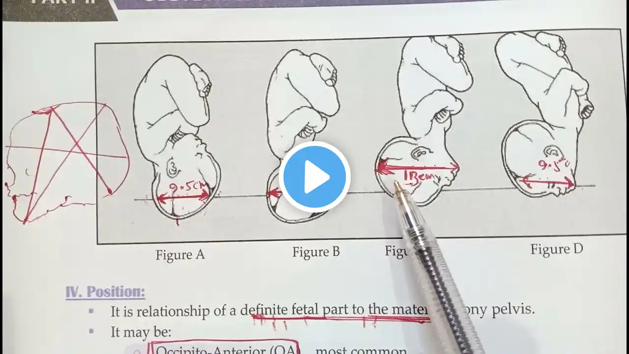 FETAL HEAD DIAMETER OBstetrics