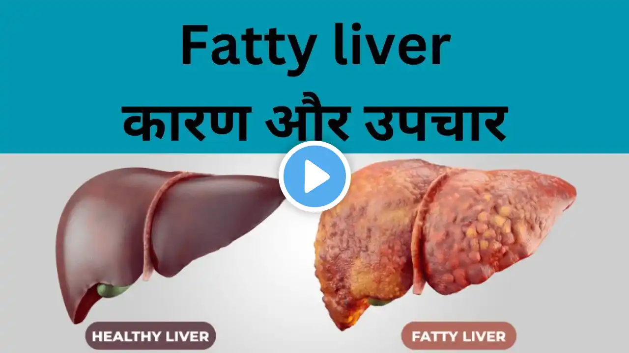 Fatty liver : Cause, Symptoms, Treatment | Fatty liver treatment in hindi