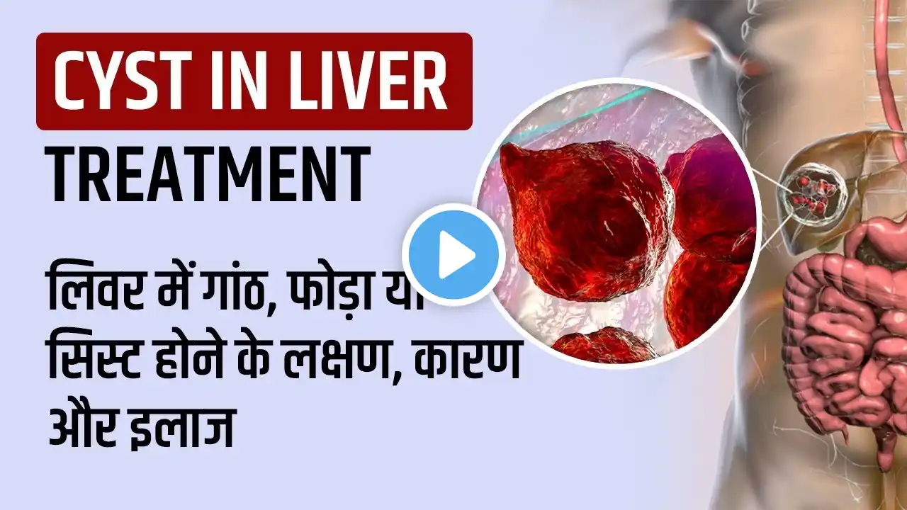 Cyst in Liver in Hindi, Symptoms, Treatment, लिवर में गांठ, फोड़ा या सिस्ट होने के लक्षण कारण और इलाज