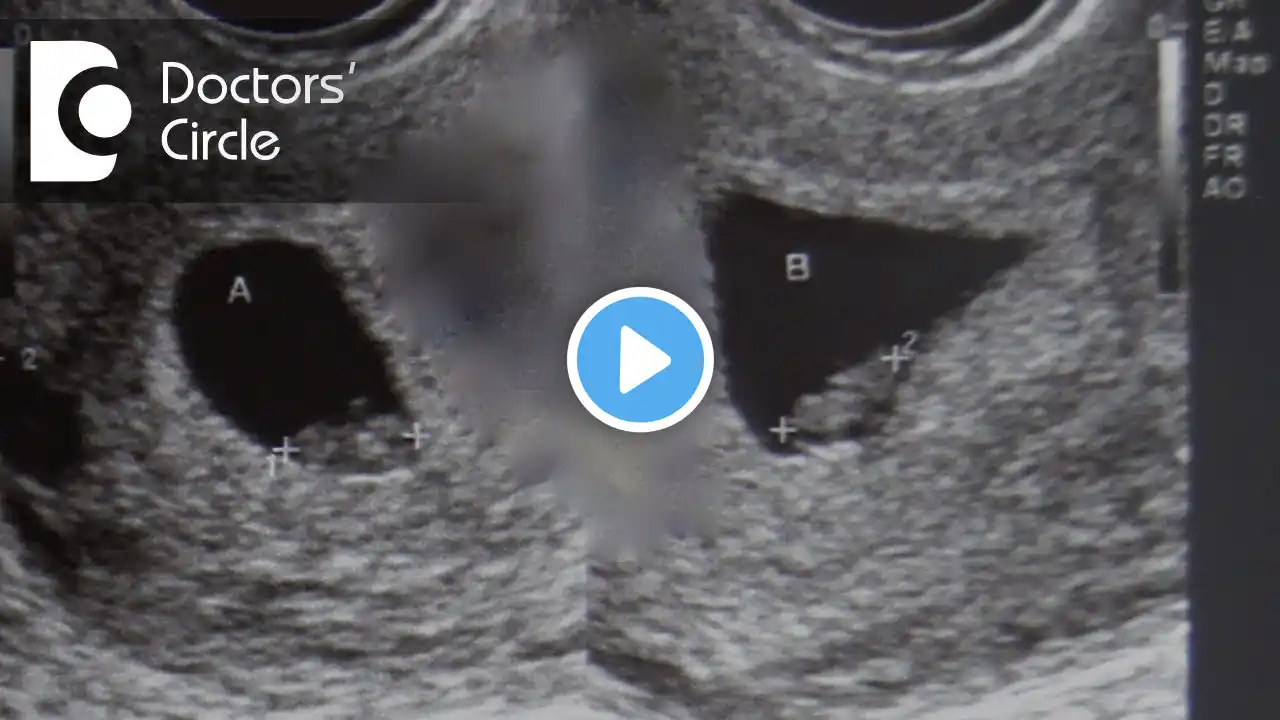 Causes of 3 weeks lag in fetal growth with no heartbeat in 9 week of gestation - Dr. Sangeeta Gomes