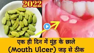 एक ही दिन में मुंह होंठ और जीभ के छाले(mouth Ulcer) को जड़ से ठीक कर देंगे यह पक्के घरेलू नुस्खे