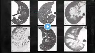 Diffuse alveolar hemorrhage 02052016