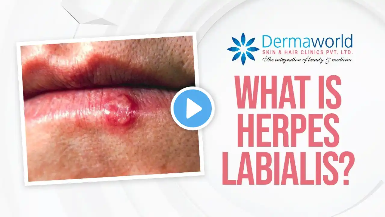 Herpes Labialis | Oral herpes | Cold Sores | Dr. Rohit Batra | Dermaworld Skin and Hair Clinics