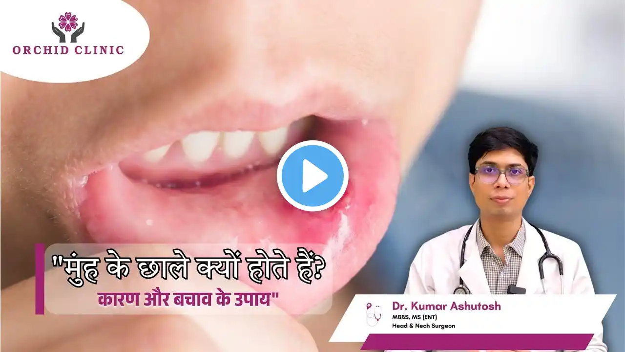 मुंह के छाले क्यों होते हैं? कारण और बचाव के उपाय | Mouth ulcer |  Dr. Kumar Ashutosh