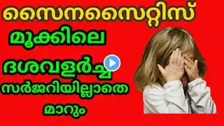 #sinusitis #headaches #treatment Sinus infections :Symptoms,Causes, Treatment സൈനസൈറ്റിസ് സിദ്ധയിൽ