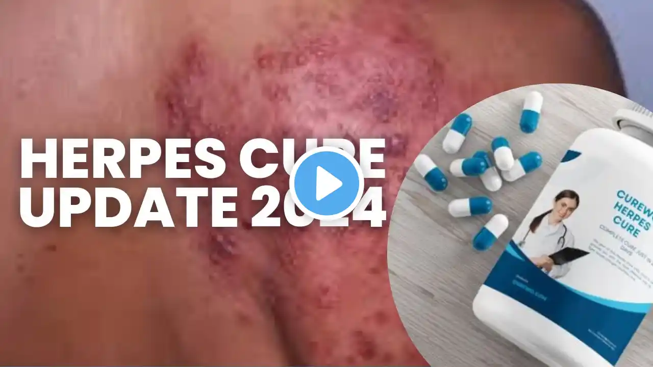 Herpes Cure Update 2024