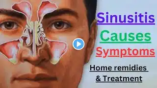 Sinusitis Infection || Symptoms, Causes,  & Treatment options