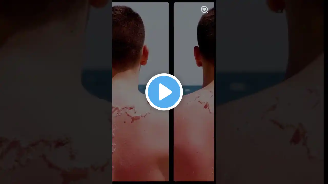 You’ll Never Believe What One Sunburn Does to Your Skin Cancer Risk Part 1 #Sharecare #Shorts