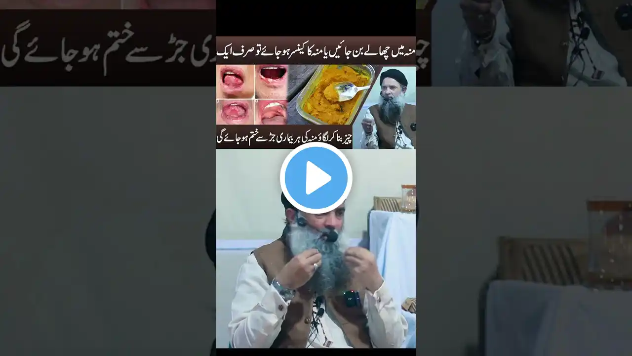 Mouth Ulcers Treatment | Muh Ke Chalo Ka Ilaj In Urdu | Muh Ke Chale Kaise Thik Kare Dr Sharafat Ali