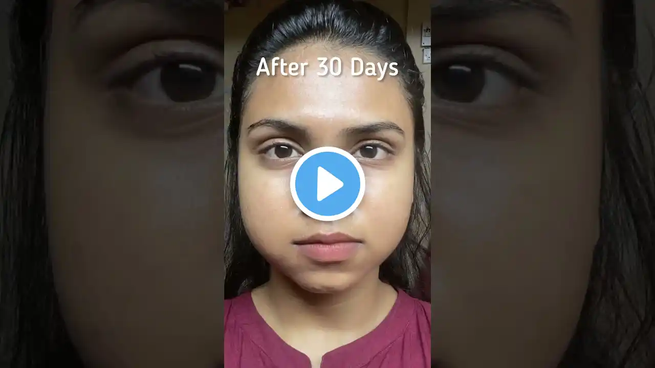 My skincare routine and acne  transformation in just 30 days #skincare #shorts #acnetreatment #acne