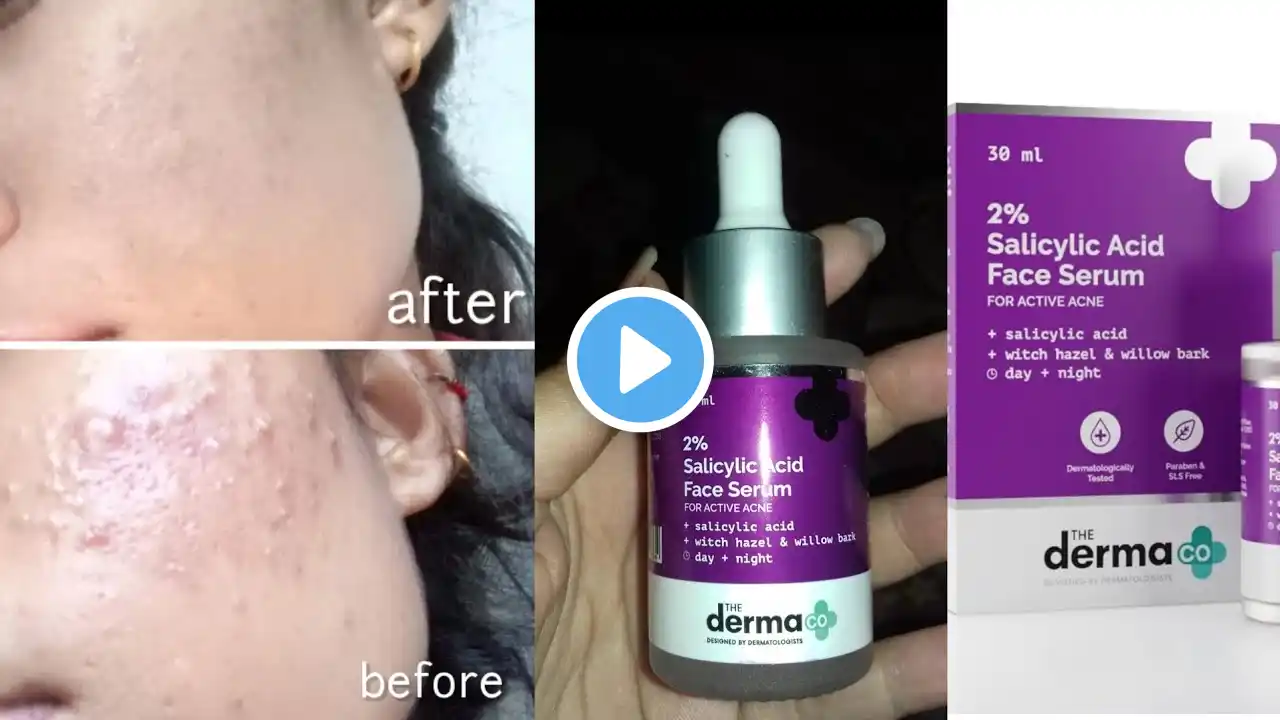 Best sirum for acne & prone skin || the derma co 2% Salicylic acid face serum review