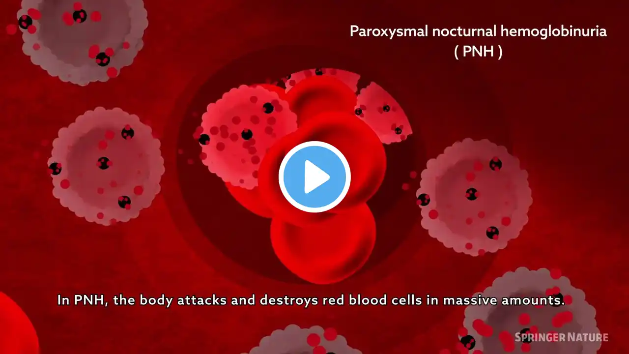 Hemolytic processes in PNH and its treatment: intravascular and extravascular hemolysis