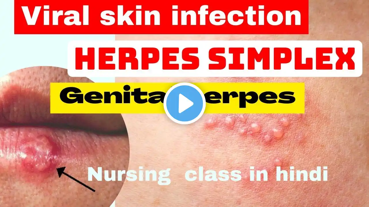 herpes simplex virus | genital herpes | viral skin infection | herpes simplex in hindi | nursing