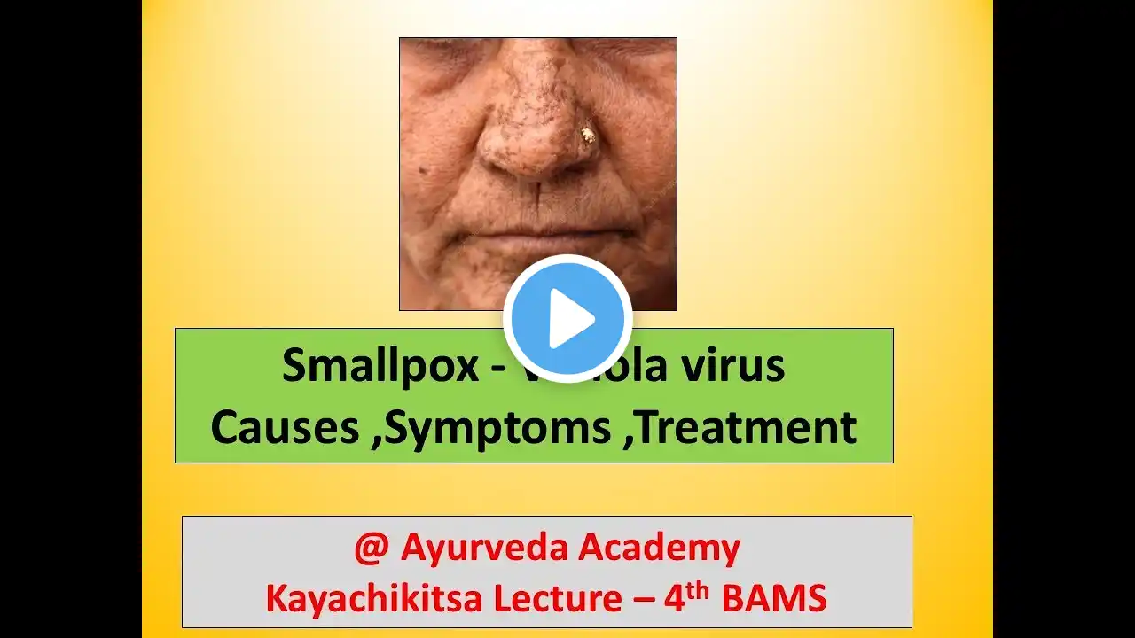 Smallpox  – causes ,symptoms ,Diagnosis ,Treatment  l Variola virus l Kayachikitsa Lecture l 4 BAMS