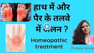 पैर के तलवे में जलन/हथेली में जलन/homoeopathic medicine for burning sensation in feet and palm