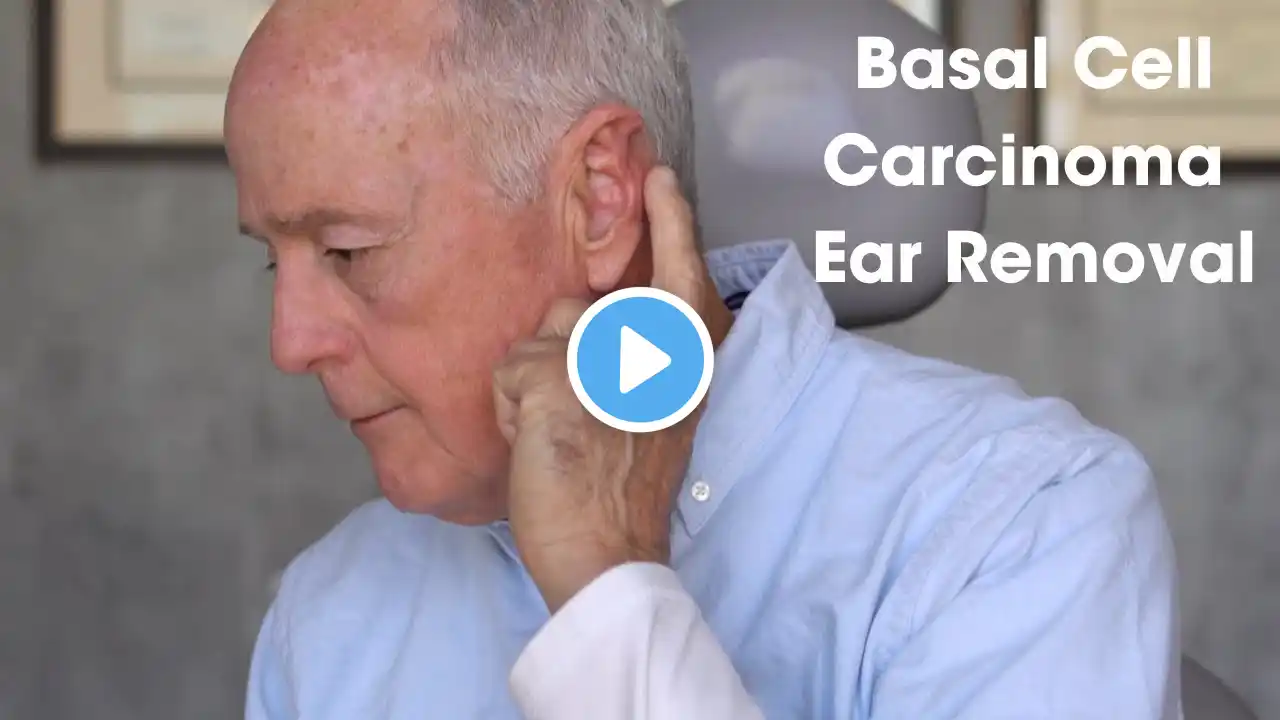 Basal Cell Carcinoma Ear Removal: Patient Testimonial Part 1