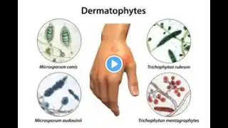 Dermatophyte Fungus infections Or tinea or ringworm ; Definition, Causes, Symptoms, Diagnosis, Treat