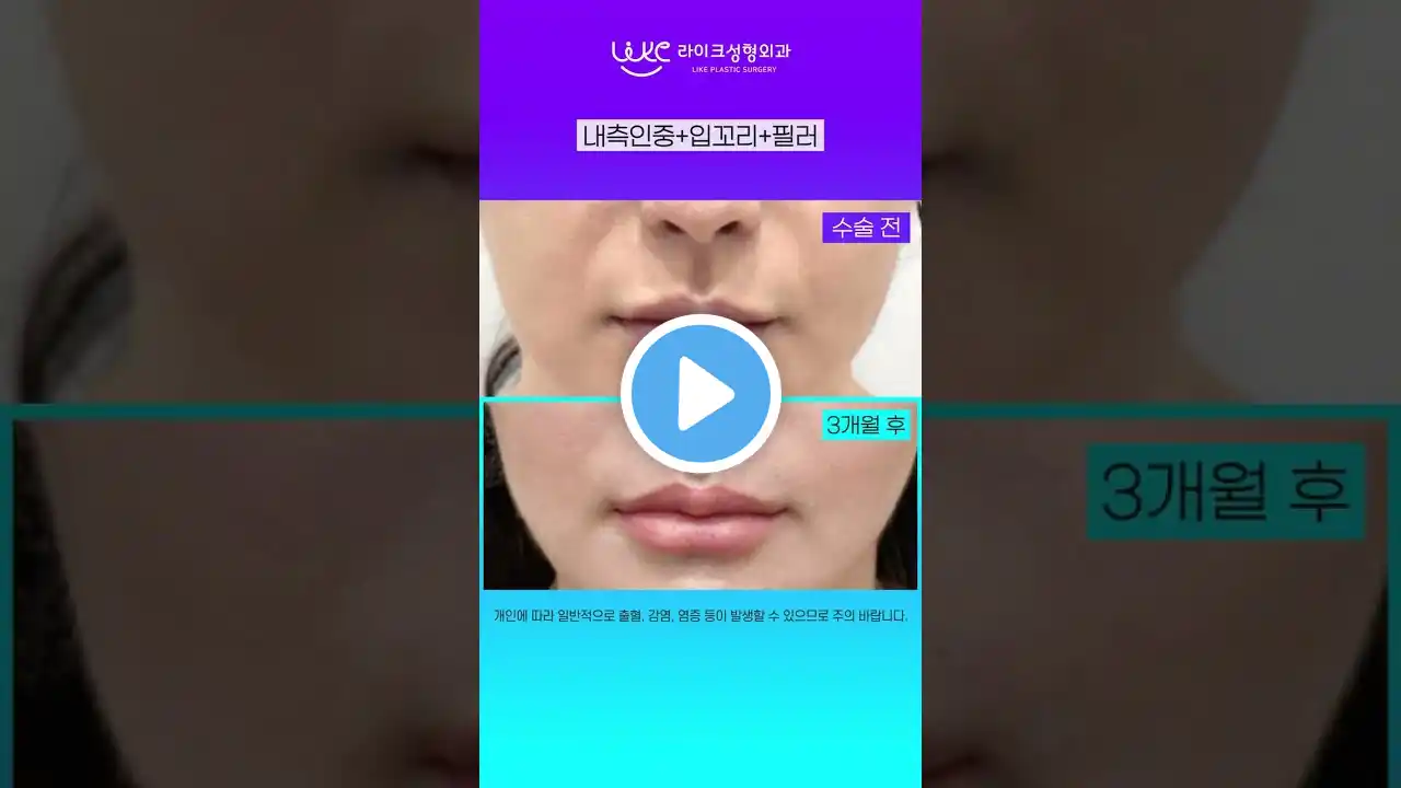 자연스럽게 줄어든 인중🤭 #리얼후기 #shorts