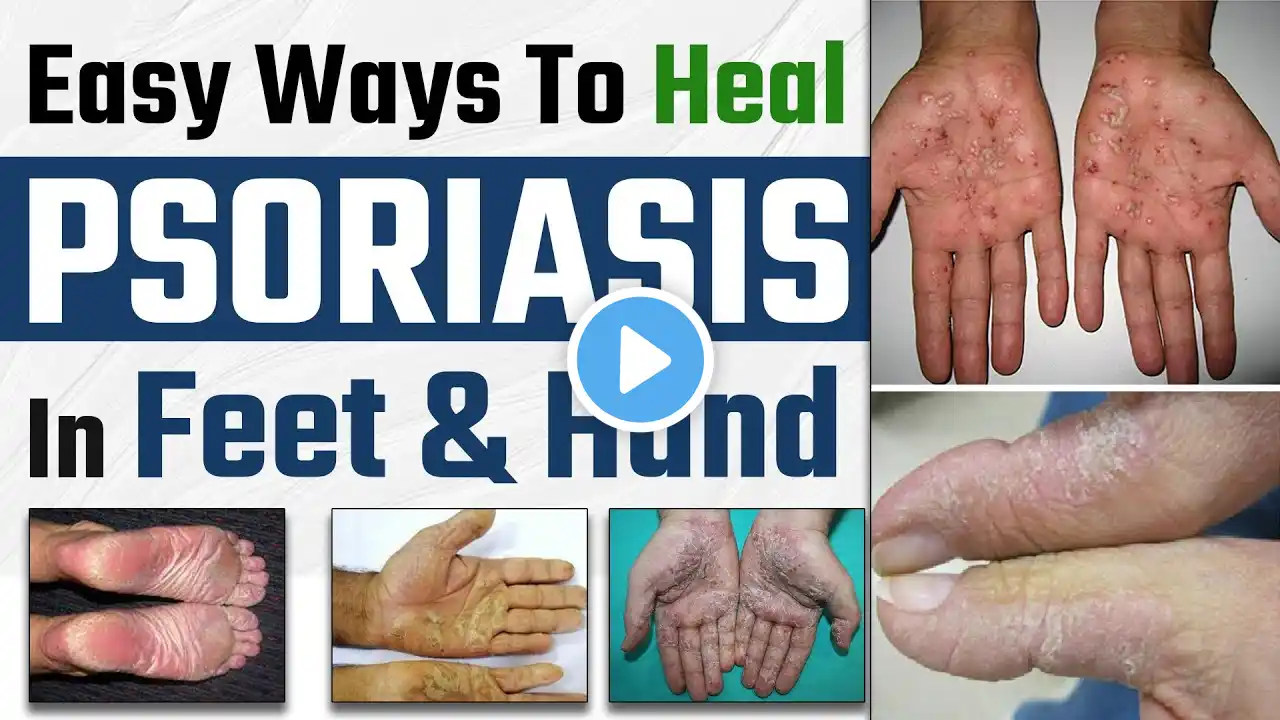 Palmoplantar Psoriasis Symptoms & Treatment | Easy Ways To Heal Psoriasis In Feet & Hand |Dr Health