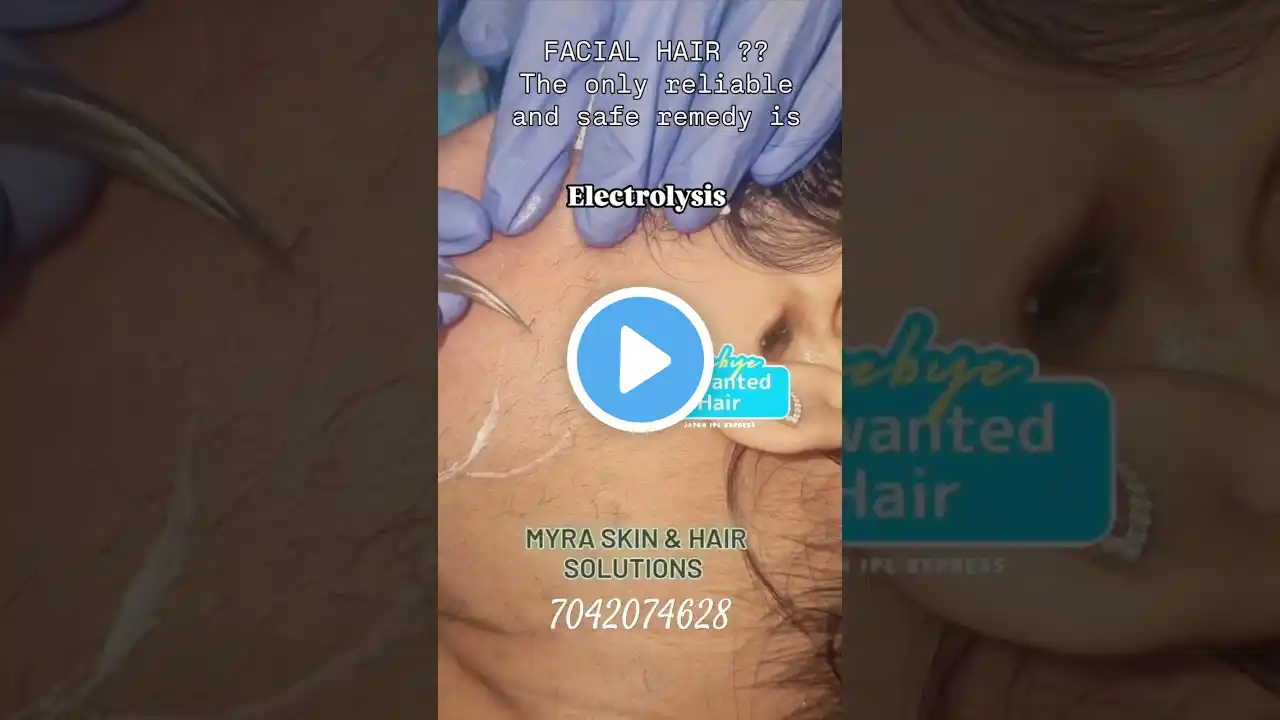 Permanent Hair Removal for facial hair by Electrolysis treatment at Myra skin clinic by Dr Sonia