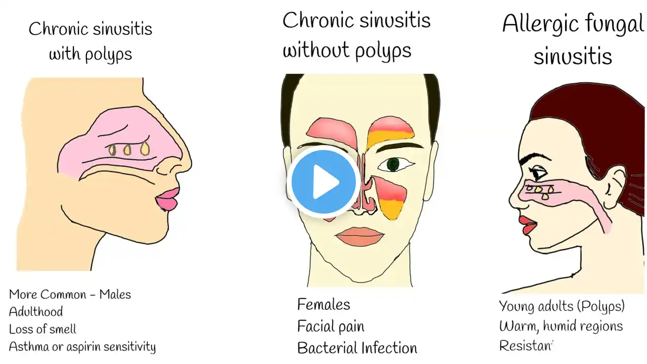 Chronic Sinusitis - Symptoms, causes and treatment. Sinusitis with polyps, Fungal sinusitis