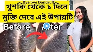 খুশকি দূর করার ঘরোয়া উপায় | How to Treat Dandruff at Home | Hair Care Tips | Home Remedies |Hair