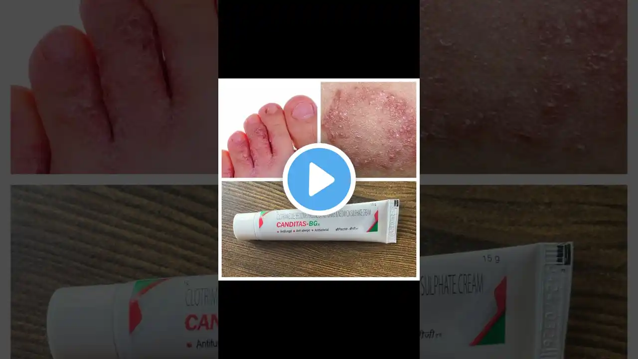 Canditas bg Fungal infection cream / Canditas bgn cream /Fungal infection in private parts / #shorts