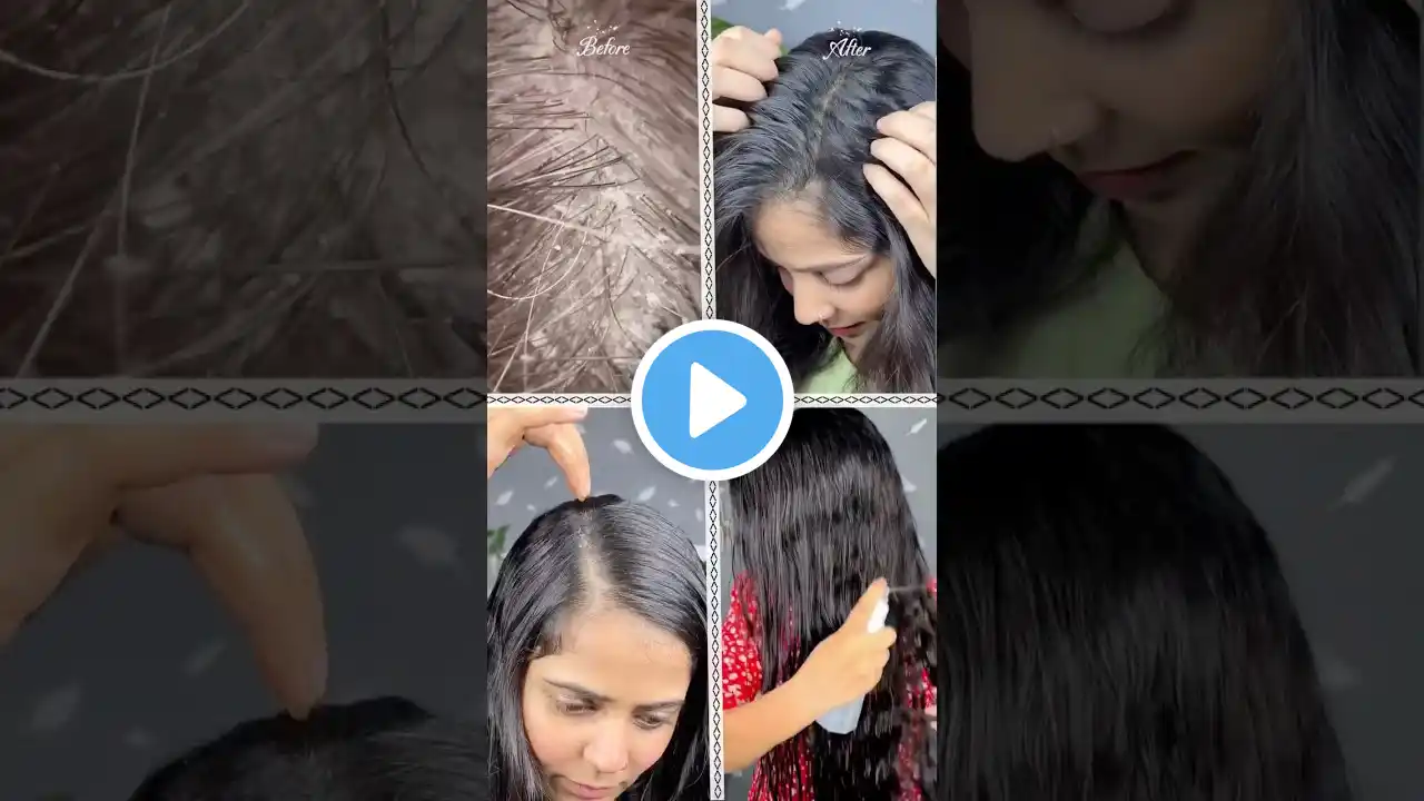 3 ways to get rid of dandruff | 3 tips to reduce dandruff permanently #haircare #dandruff #winter