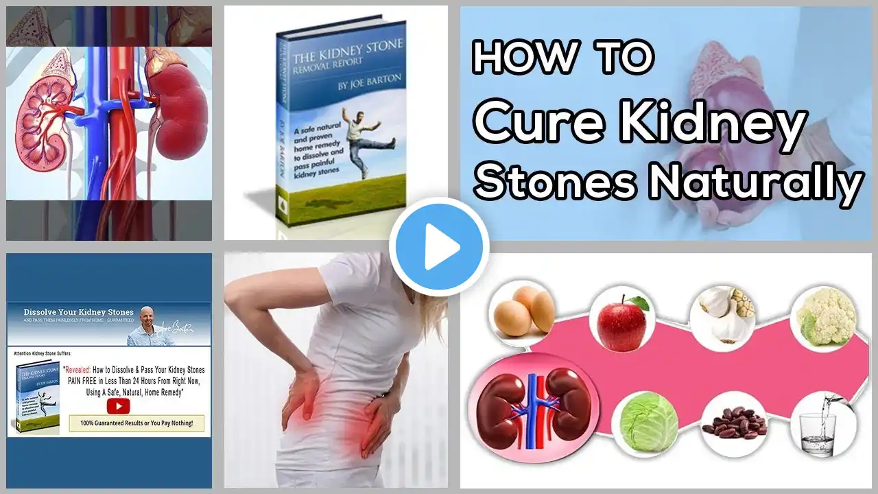 How To Cure Kidney Stones Naturally | The Kidney Stone Removal Report | Best Review 2019