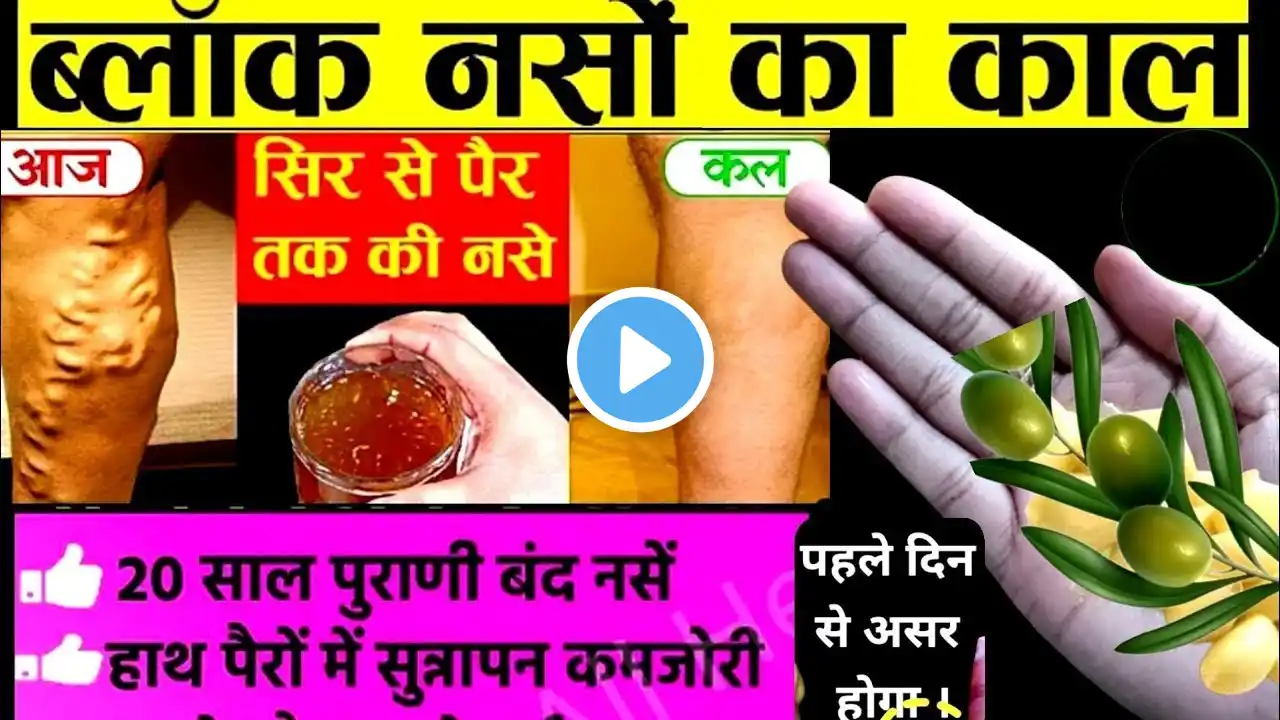 नसों में दर्द +कमजोरी ,दबी हुई नस,Varicose Vein, साइटिका Slip Disc Pain , 100% ठीक