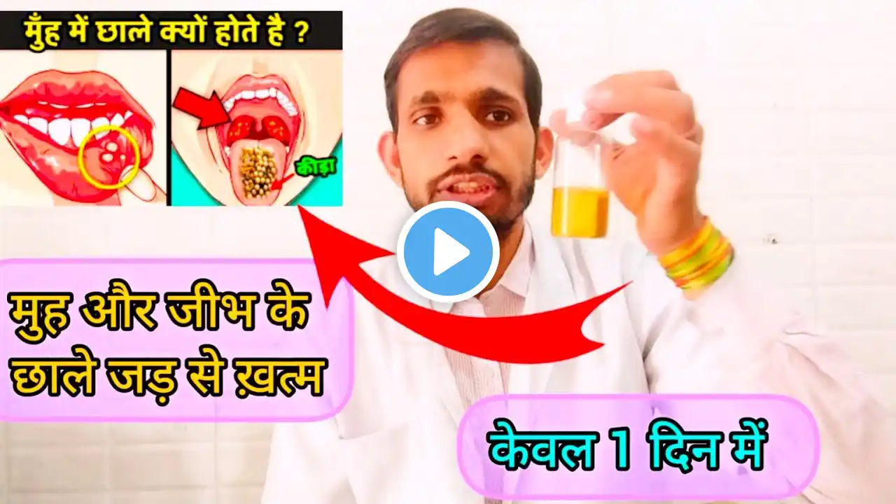 एक बार में मुंह के छाले गायब । मुंह के छालों (Mouth Ulcers) का घरेलू उपचार ।