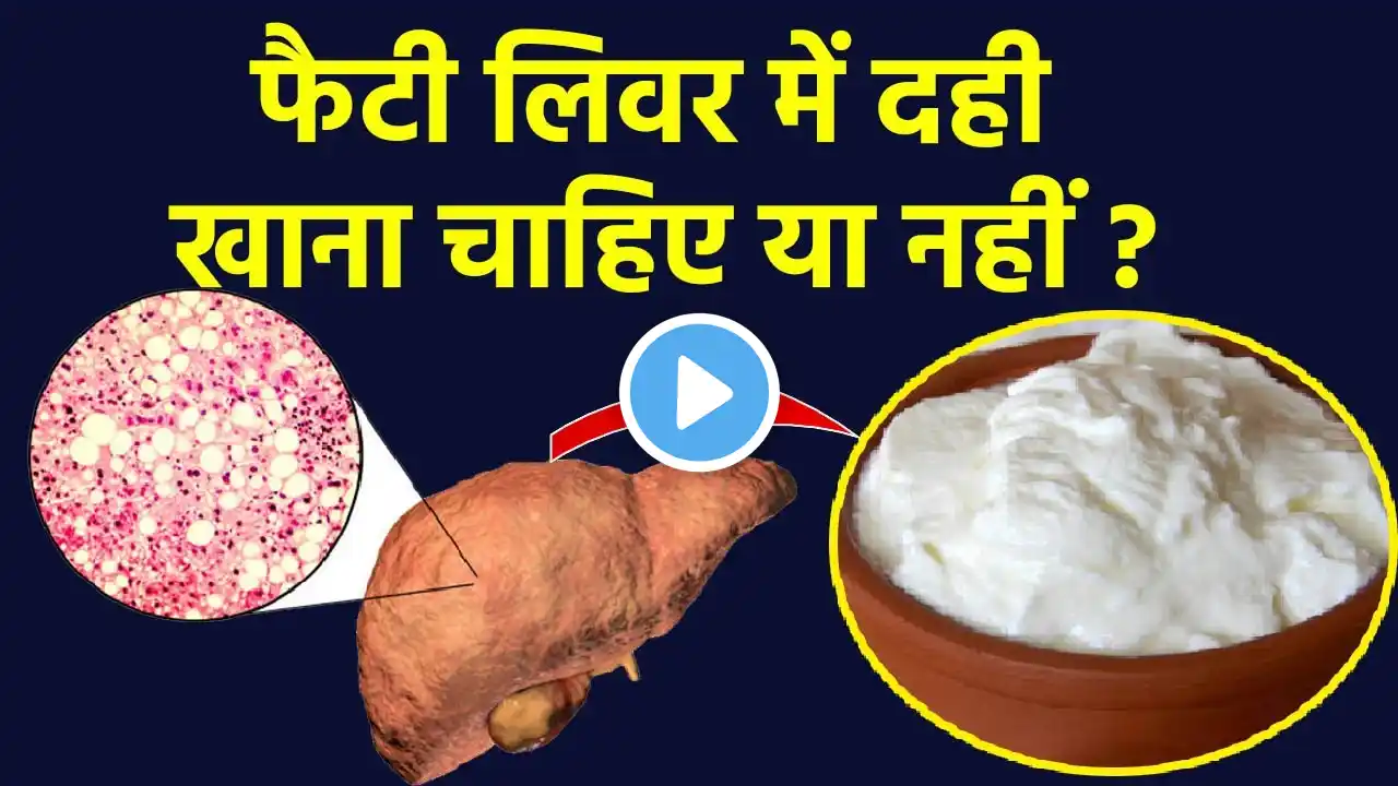 फैटी लिवर में दही खाना चाहिए या नहीं, Is Curd Good for Fatty Liver | Boldsky *Health