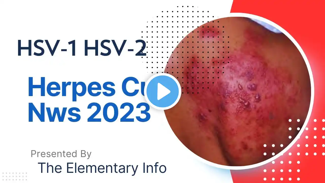 Herpes News About Herpes Cure 2023 | The Elementary Info