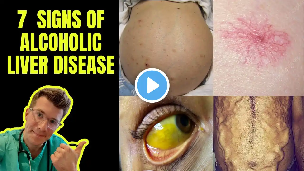 Doctor outlines 7 signs of Alcoholic Liver Disease (ascites, Caput Medusae, jaundice & more)