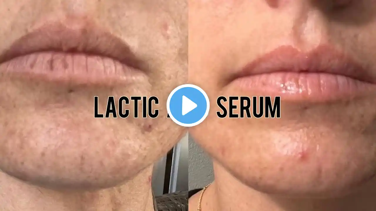 Homemade Lactic Acid Serum👌Remove Acne, Wrinkles, and Dark Spots Naturally