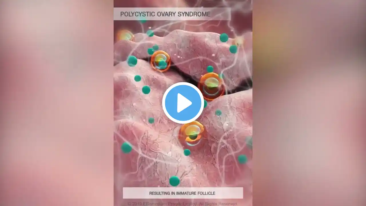 What is Polycystic Ovary Syndrome (PCOS) 3D Guide #dratv #pcos #pcosawareness #medical #doctor